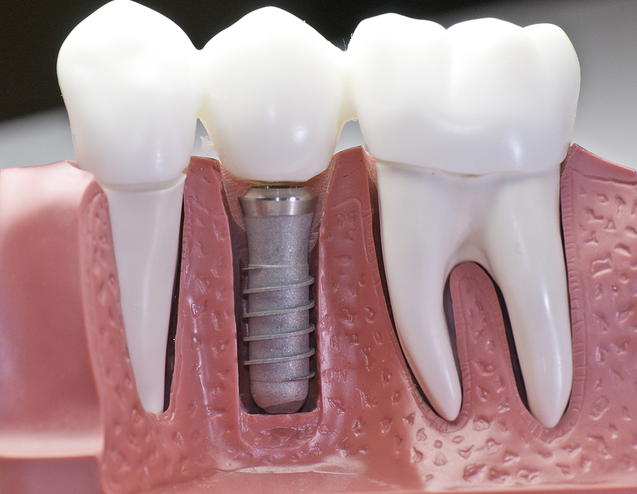 The Ultimate Guide to Dental Implants in Chesapeake, VA: Restoring Your Smile with Confidence